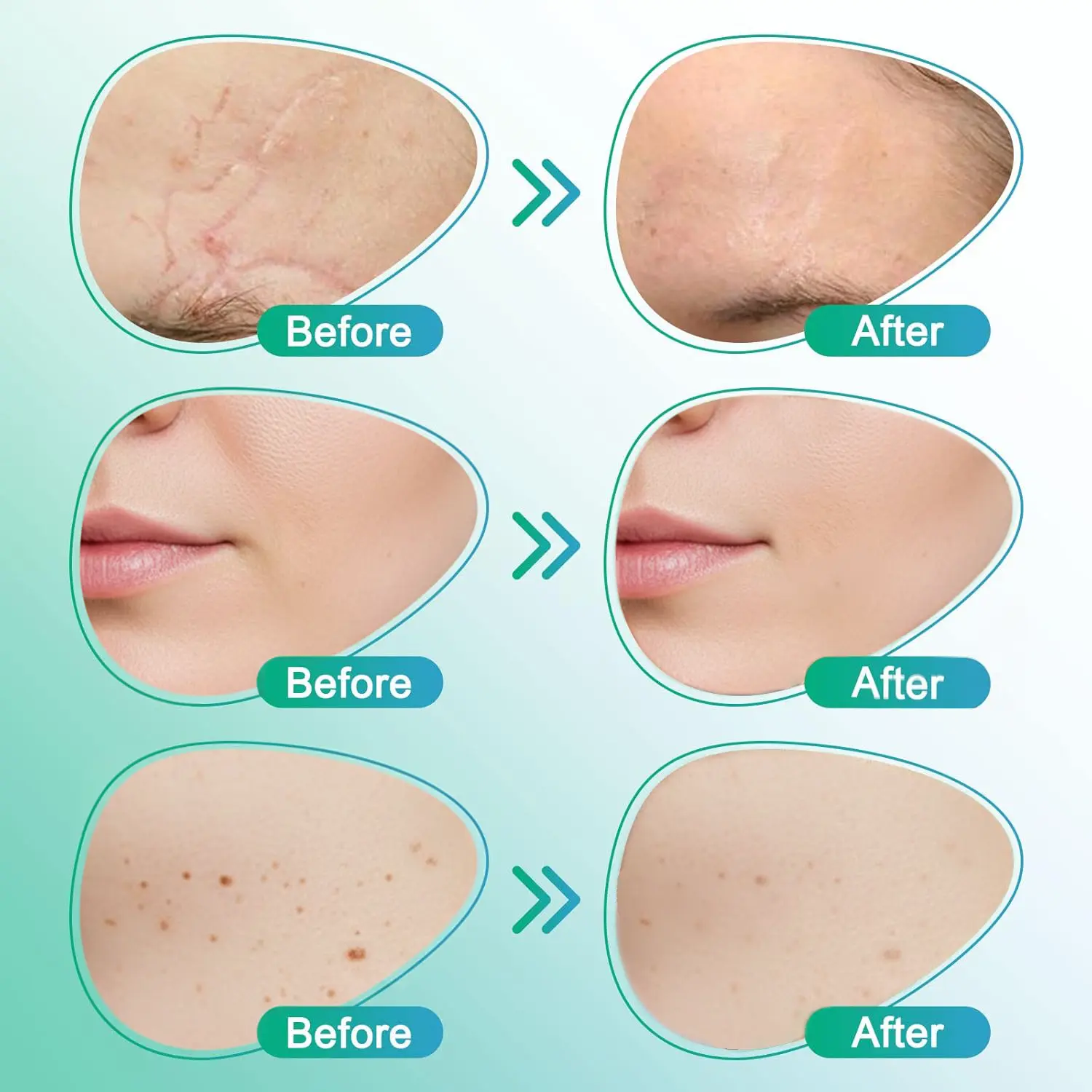 𝗖𝗮𝗿𝗲𝗕𝗿𝗲𝗲𝘇𝗲® Лепенка за грижа с микроигли 3 в 1 - Image 5